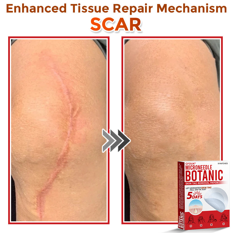 🗽👨⚕️GFOUK® MicroNeedle Botanic Skin Tag Removal Patch 🇺🇸 Made in the USA