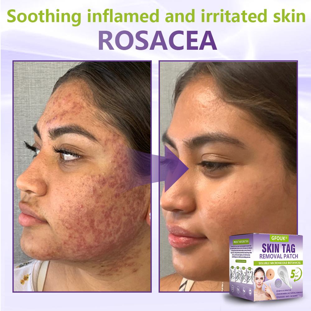 𝐎𝐟𝐟𝐢𝐜𝐢𝐚𝐥 𝐒𝐭𝐨𝐫𝐞 🇺🇸 |🗽✨GFOUK® Soluble Microneedle Botanical Skin Tag Removal Patch