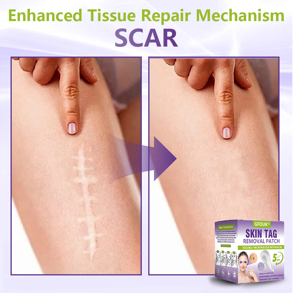 𝐎𝐟𝐟𝐢𝐜𝐢𝐚𝐥 𝐒𝐭𝐨𝐫𝐞 🇺🇸 |🗽✨GFOUK® Soluble Microneedle Botanical Skin Tag Removal Patch