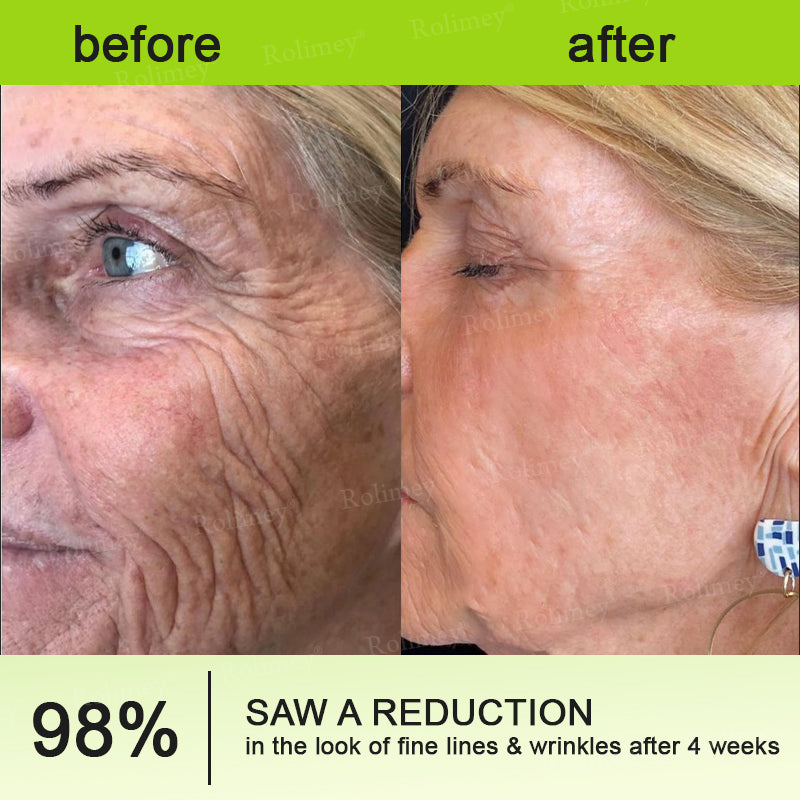 🇺🇸 Made and shipped from the USA 🗽🔖Rolimey® Botox & Vita-A Retinol Shot Wrinkle-Lift Tightening cream - Last Day Promotion 50% OFF