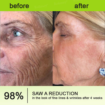 🇺🇸 Made and shipped from the USA 🗽🔖Rolimey® Botox & Vita-A Retinol Shot Wrinkle-Lift Tightening cream - Last Day Promotion 50% OFF