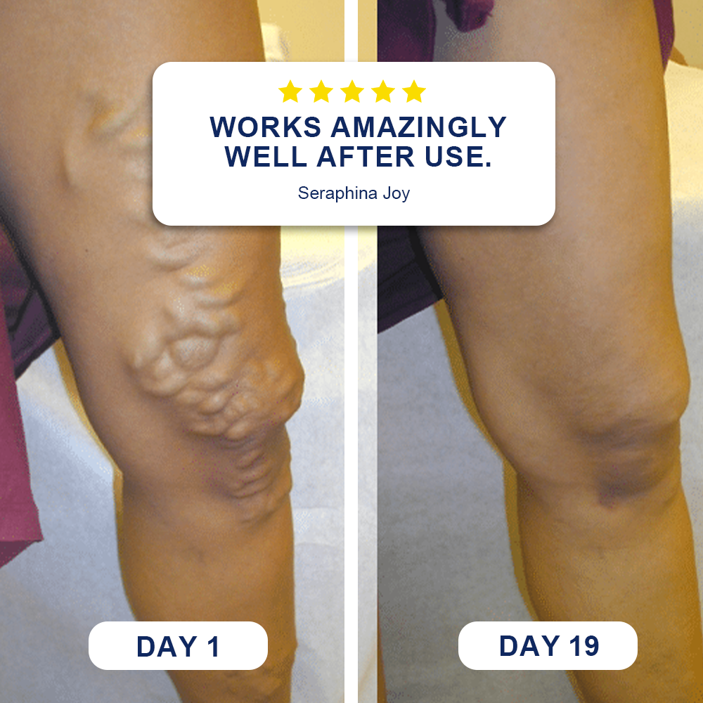 🗽Evolvion® Skin Bruise Repair & Veins Strengthening Cream