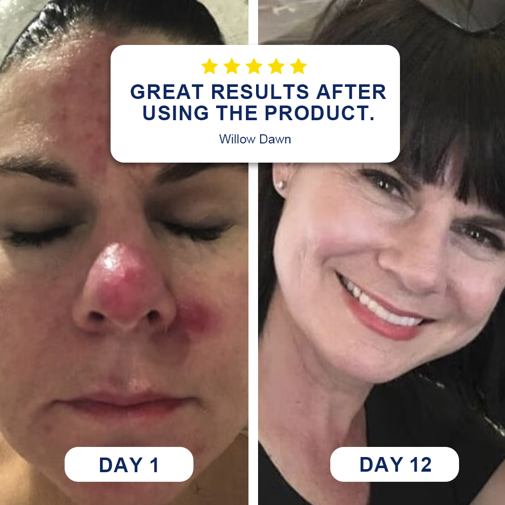 🗽Evolvion® Skin Bruise Repair & Veins Strengthening Cream