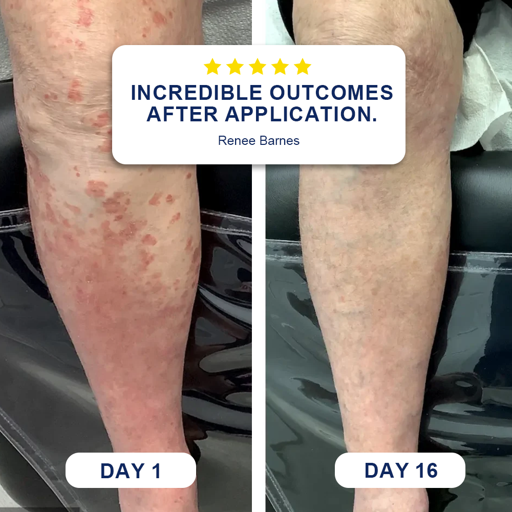 🗽Evolvion® Skin Bruise Repair & Veins Strengthening Cream