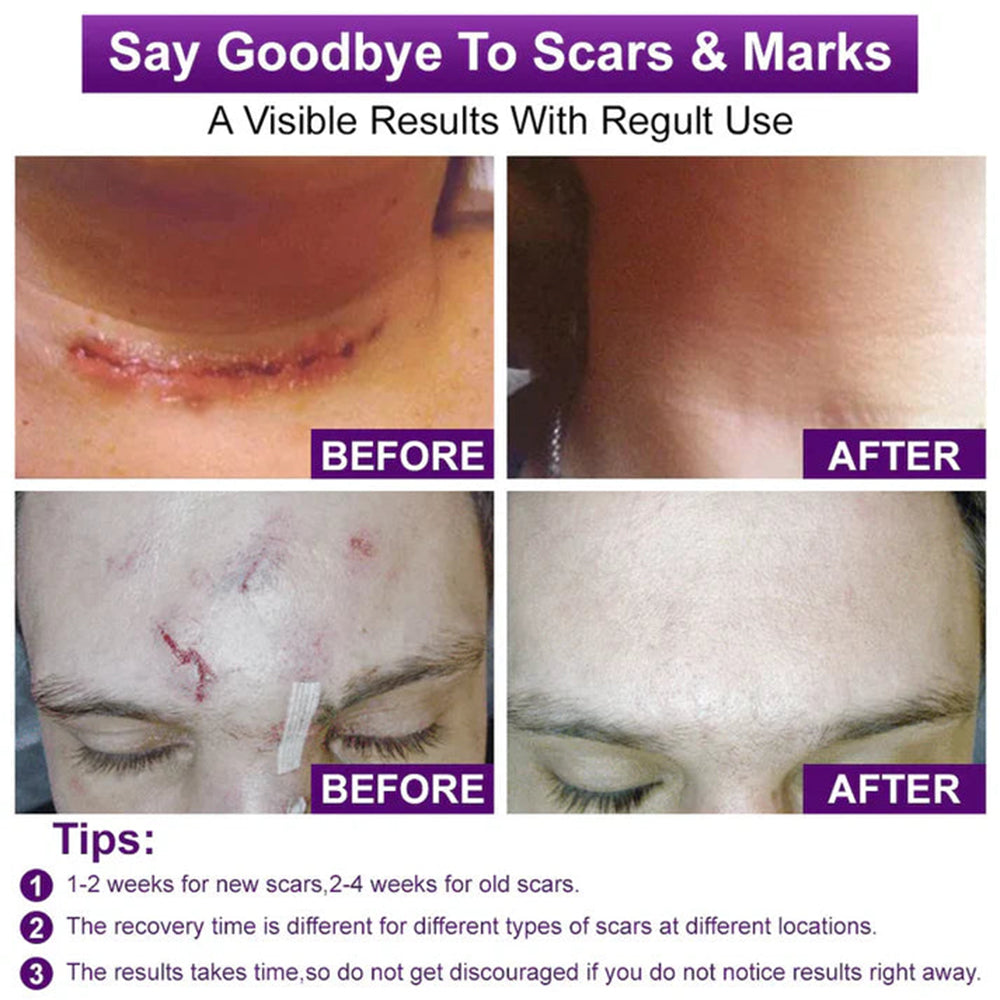 Celsiora® Stem Cell Scar Gel –🗽Treats old and new scars, helps reduce the appearance of scars from acne, surgery, burns, injuries, and stretch marks