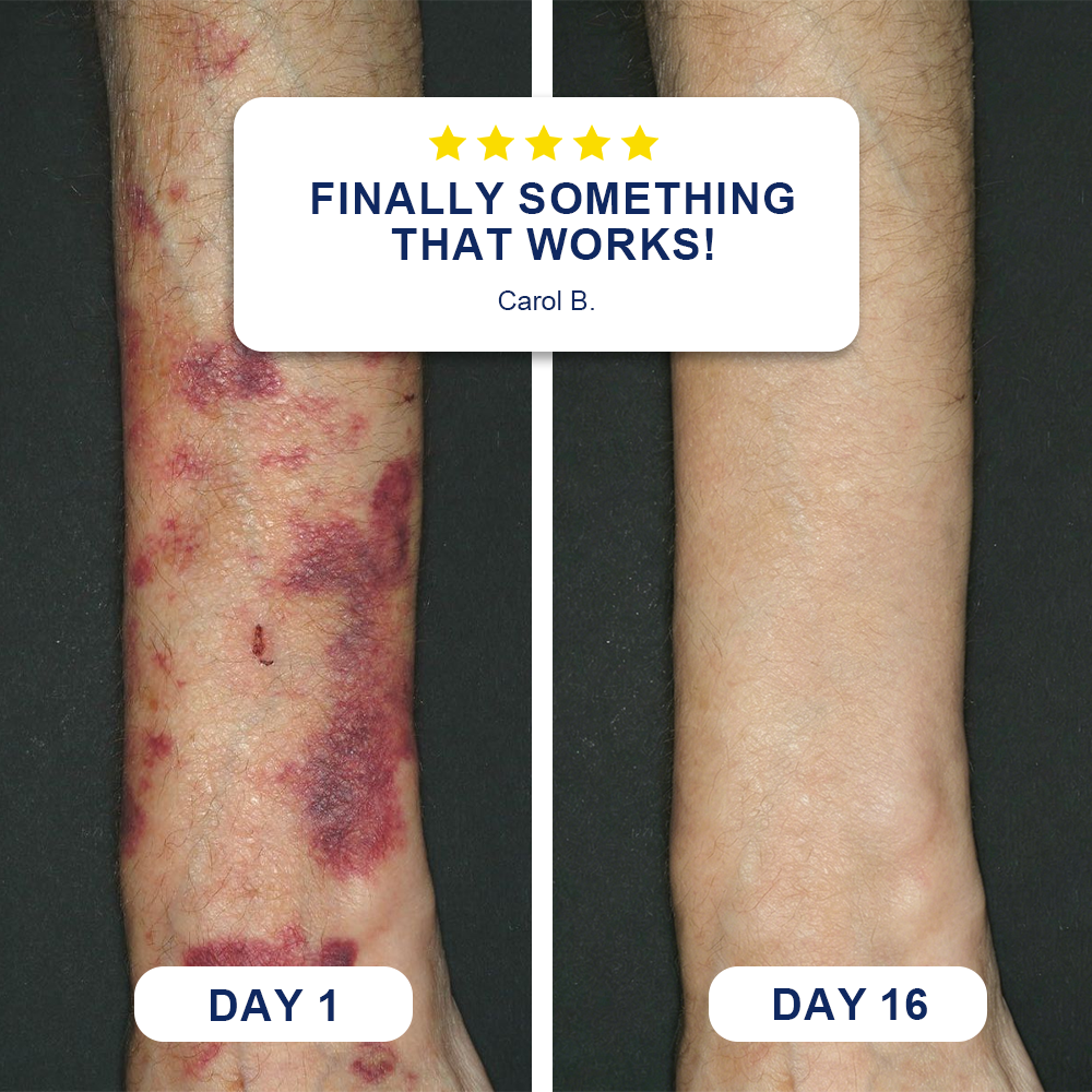 ✨Evolvion® Bruise Repair & Skin-Strengthening Cream