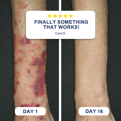 ✨Evolvion® Bruise Repair & Skin-Strengthening Cream