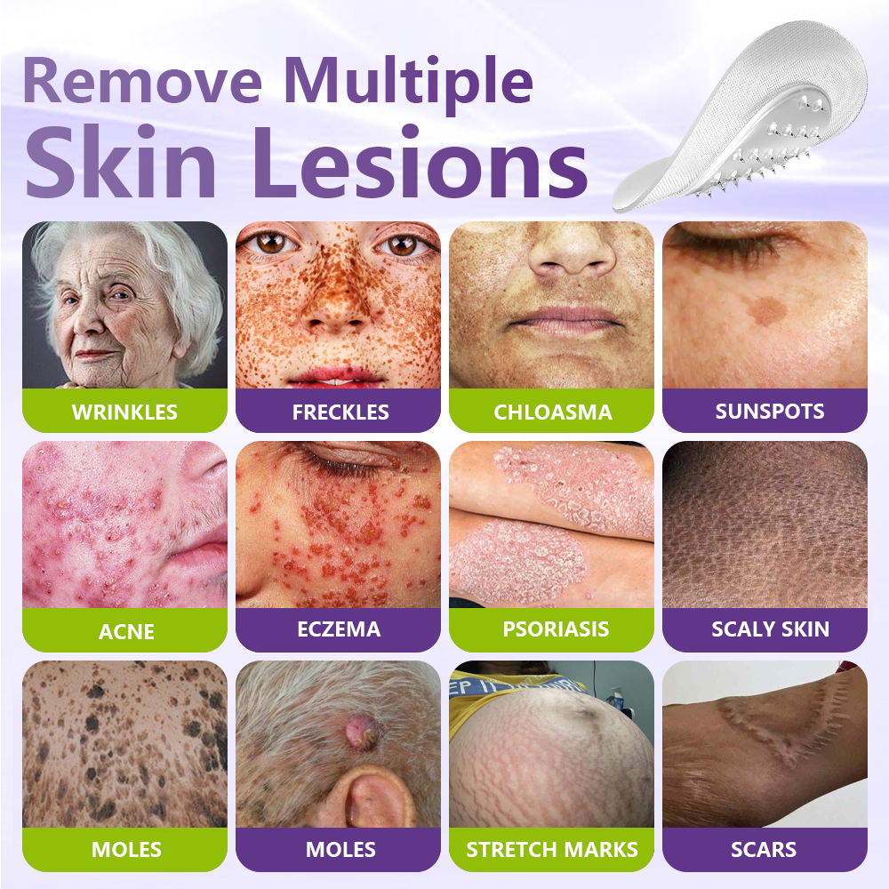 𝐎𝐟𝐟𝐢𝐜𝐢𝐚𝐥 𝐒𝐭𝐨𝐫𝐞 🇺🇸 |🗽✨GFOUK® Soluble Microneedle Botanical Skin Tag Removal Patch