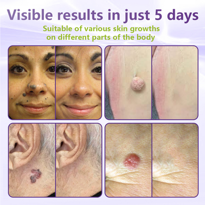 𝐎𝐟𝐟𝐢𝐜𝐢𝐚𝐥 𝐒𝐭𝐨𝐫𝐞 🇺🇸 |🗽✨GFOUK® Soluble Microneedle Botanical Skin Tag Removal Patch