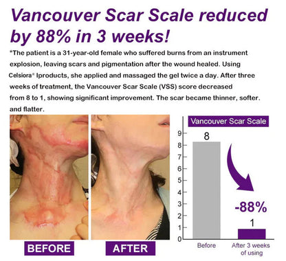 Celsiora® Stem Cell Scar Gel –🗽Treats old and new scars, helps reduce the appearance of scars from acne, surgery, burns, injuries, and stretch marks