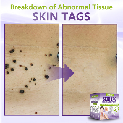 𝐎𝐟𝐟𝐢𝐜𝐢𝐚𝐥 𝐒𝐭𝐨𝐫𝐞 🇺🇸 |🗽✨GFOUK® Soluble Microneedle Botanical Skin Tag Removal Patch