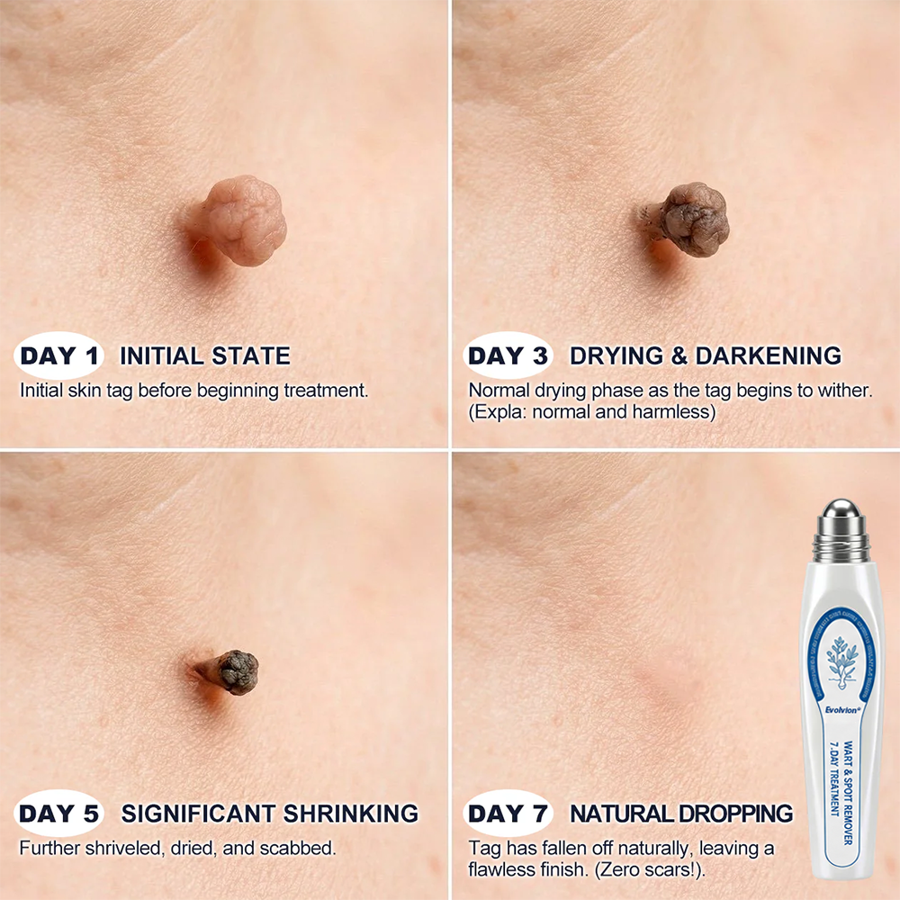 Made and Shipped from USA ✨Evolvion® 𝟕-𝐃𝒂𝘆 𝐒𝗸𝐢𝐧 𝐓𝒂𝗴 & 𝐒𝐩𝙤𝐭 𝐄𝐫𝒂𝐬𝙚𝐫 Painless & Scar-Free Advanced Imperfection Remova𝗜 Ro𝗜𝗜erba𝗜𝗜 Pen