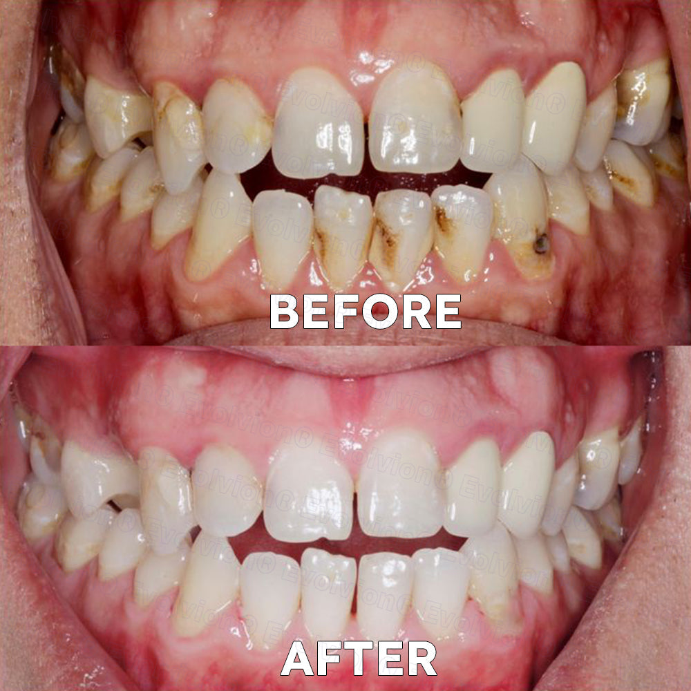 ✅Official Store |🗽Evolvion® Fluoride-Free Nano Hydroxyapatite Tooth Powder👨‍⚕️(Treats periodontitis and mouth ulcers, prevents tooth loss, and repairs gum recession)