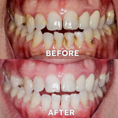 ✅Official Store |🗽Evolvion® Fluoride-Free Nano Hydroxyapatite Tooth Powder👨‍⚕️(Treats periodontitis and mouth ulcers, prevents tooth loss, and repairs gum recession)