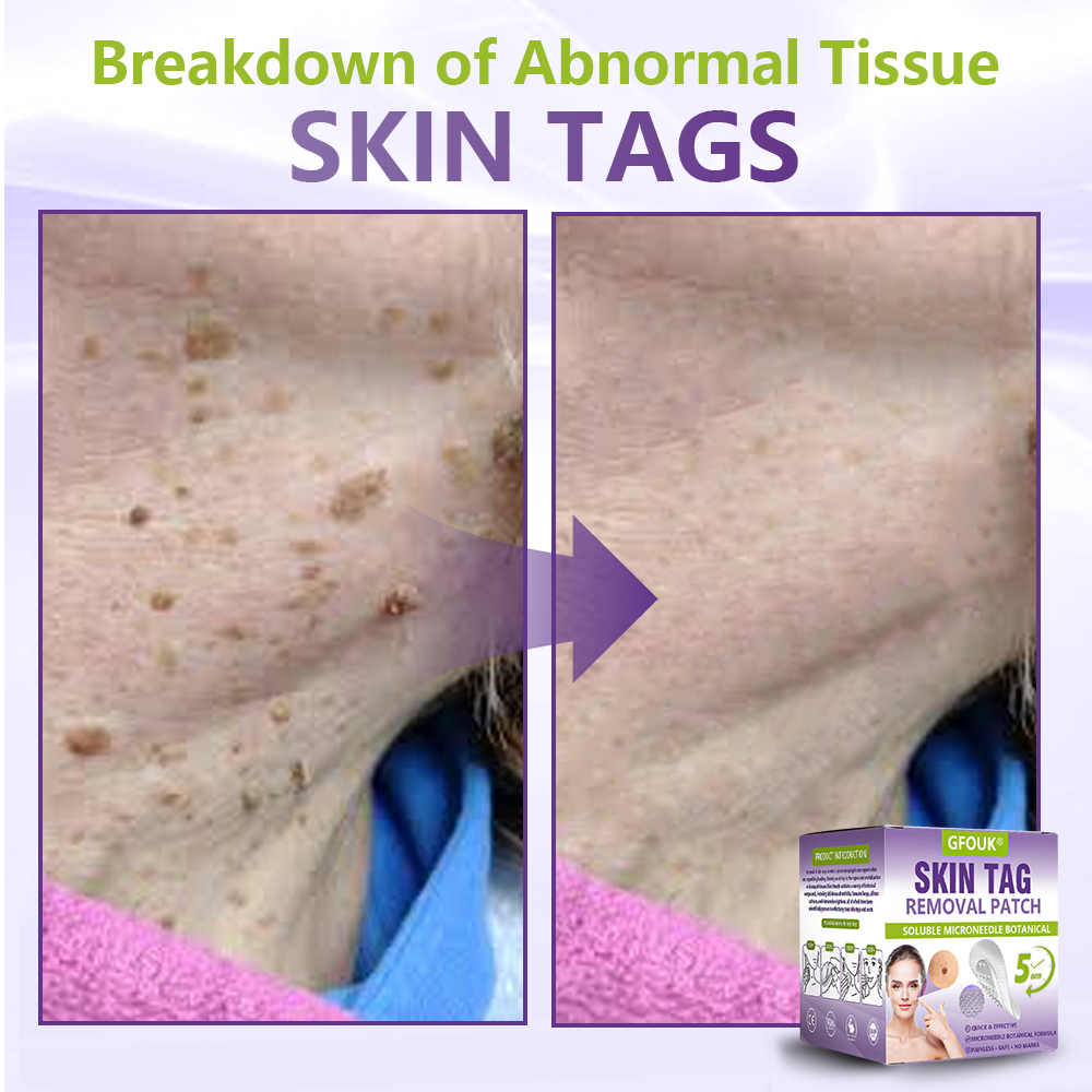 𝐎𝐟𝐟𝐢𝐜𝐢𝐚𝐥 𝐒𝐭𝐨𝐫𝐞 🇺🇸 |🗽✨GFOUK® Soluble Microneedle Botanical Skin Tag Removal Patch