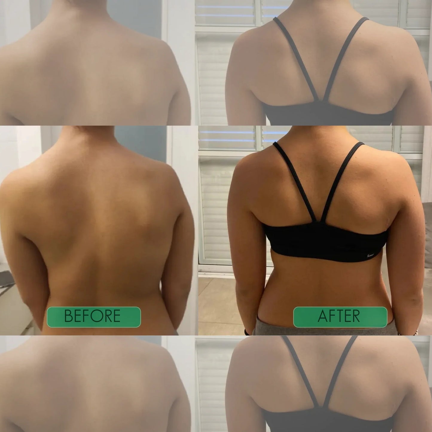 🧍‍♂️Avasoma® |🗽Professional Posture Corrector.Discreetly invisible under clothes for lasting spinal health. Start standing better!