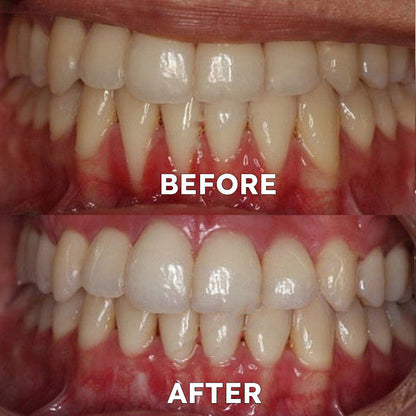 ✅Official Store |🗽Evolvion® Fluoride-Free Nano Hydroxyapatite Tooth Powder👨‍⚕️(Treats periodontitis and mouth ulcers, prevents tooth loss, and repairs gum recession)