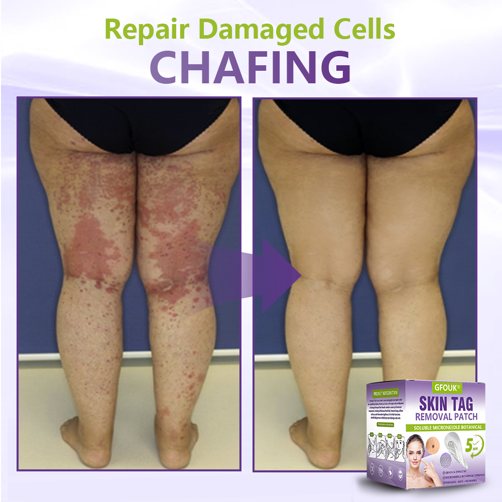 𝐎𝐟𝐟𝐢𝐜𝐢𝐚𝐥 𝐒𝐭𝐨𝐫𝐞 🇺🇸 |🗽✨GFOUK® Soluble Microneedle Botanical Skin Tag Removal Patch