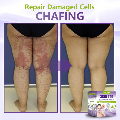 𝐎𝐟𝐟𝐢𝐜𝐢𝐚𝐥 𝐒𝐭𝐨𝐫𝐞 🇺🇸 |🗽✨GFOUK® Soluble Microneedle Botanical Skin Tag Removal Patch