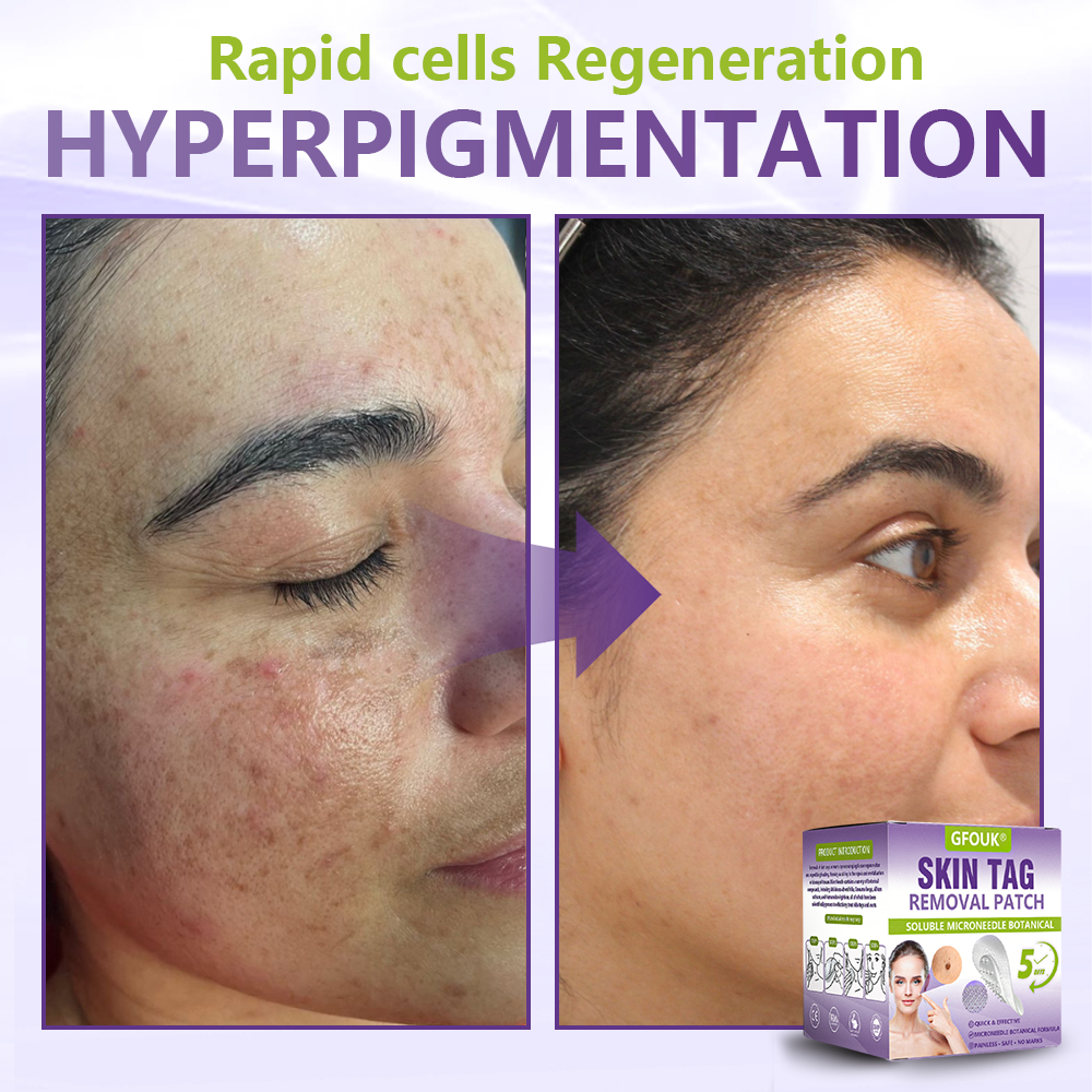 𝐎𝐟𝐟𝐢𝐜𝐢𝐚𝐥 𝐒𝐭𝐨𝐫𝐞 🇺🇸 |🗽✨GFOUK® Soluble Microneedle Botanical Skin Tag Removal Patch