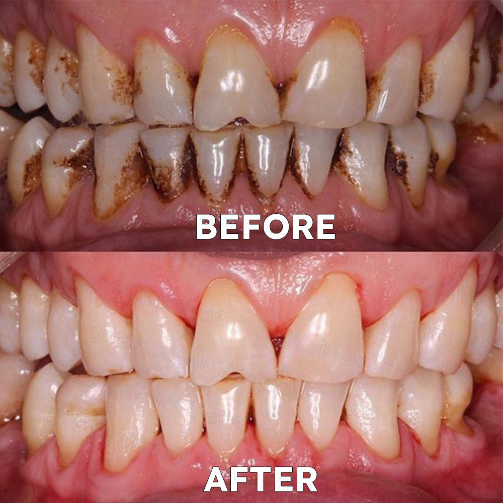 ✅Official Store |🗽Evolvion® Fluoride-Free Nano Hydroxyapatite Tooth Powder👨‍⚕️(Treats periodontitis and mouth ulcers, prevents tooth loss, and repairs gum recession)