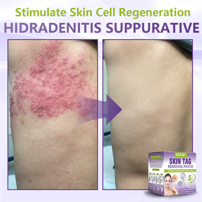 𝐎𝐟𝐟𝐢𝐜𝐢𝐚𝐥 𝐒𝐭𝐨𝐫𝐞 🇺🇸 |🗽✨GFOUK® Soluble Microneedle Botanical Skin Tag Removal Patch