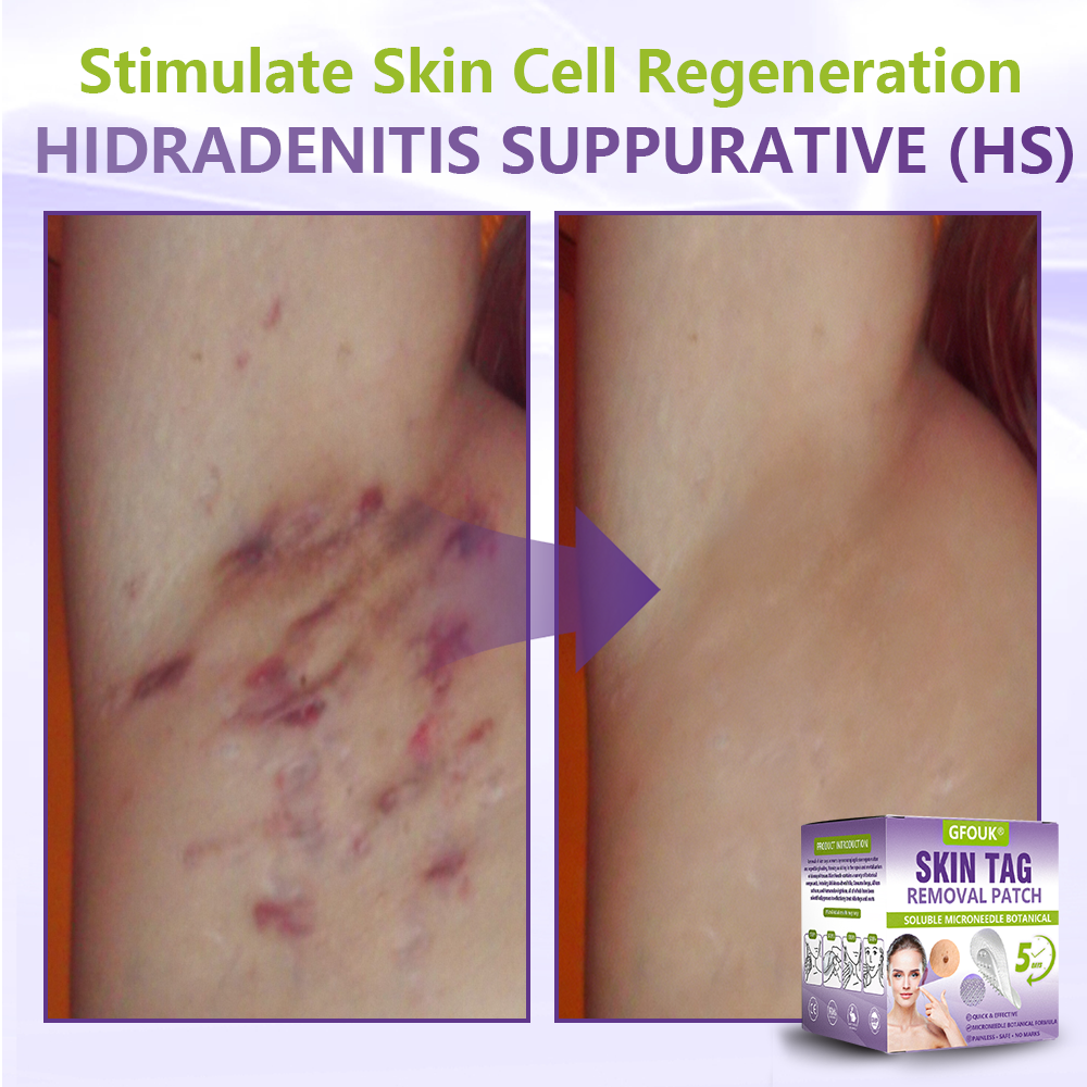 𝐎𝐟𝐟𝐢𝐜𝐢𝐚𝐥 𝐒𝐭𝐨𝐫𝐞 🇺🇸 |🗽✨GFOUK® Soluble Microneedle Botanical Skin Tag Removal Patch