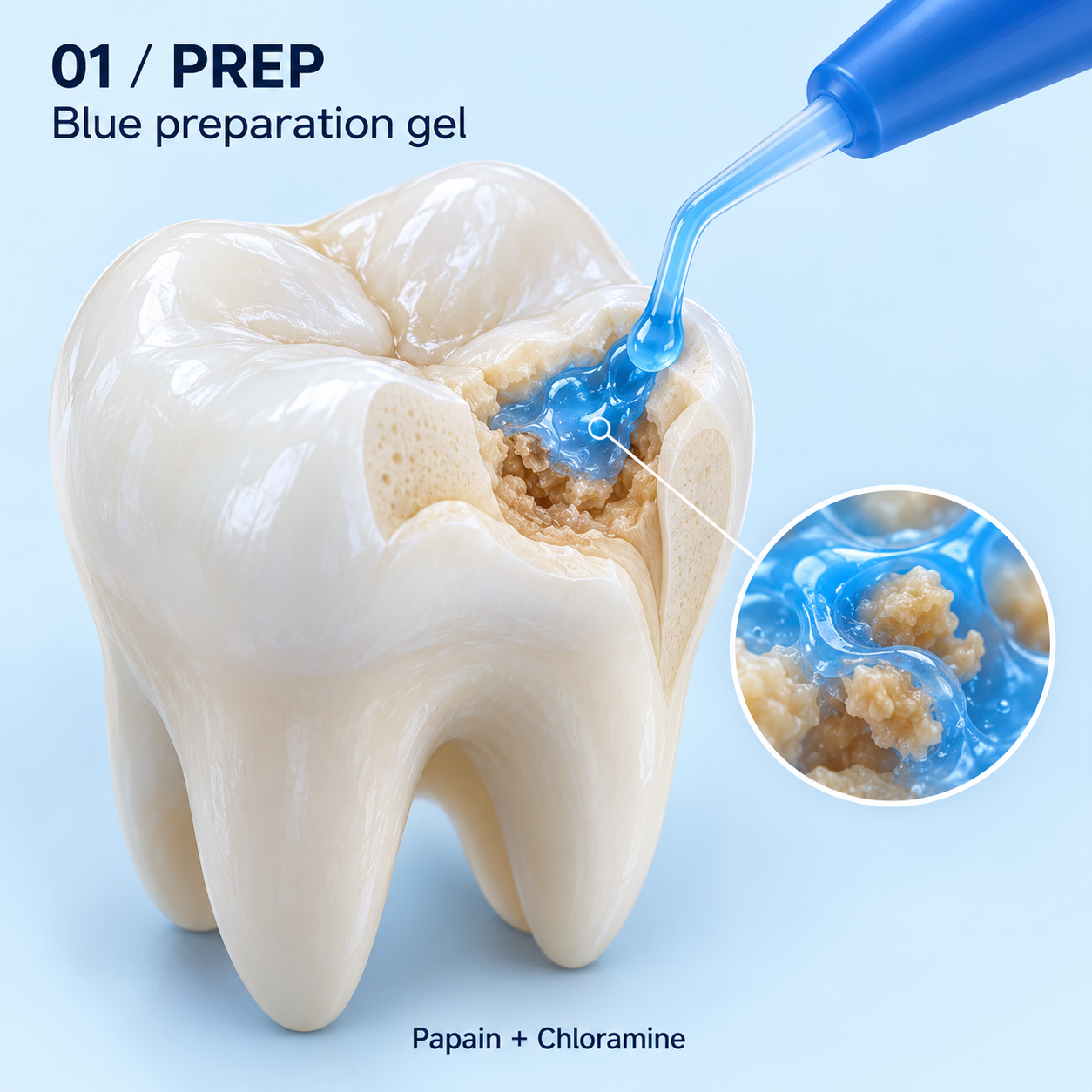 Blue preparation gel and white repair composite