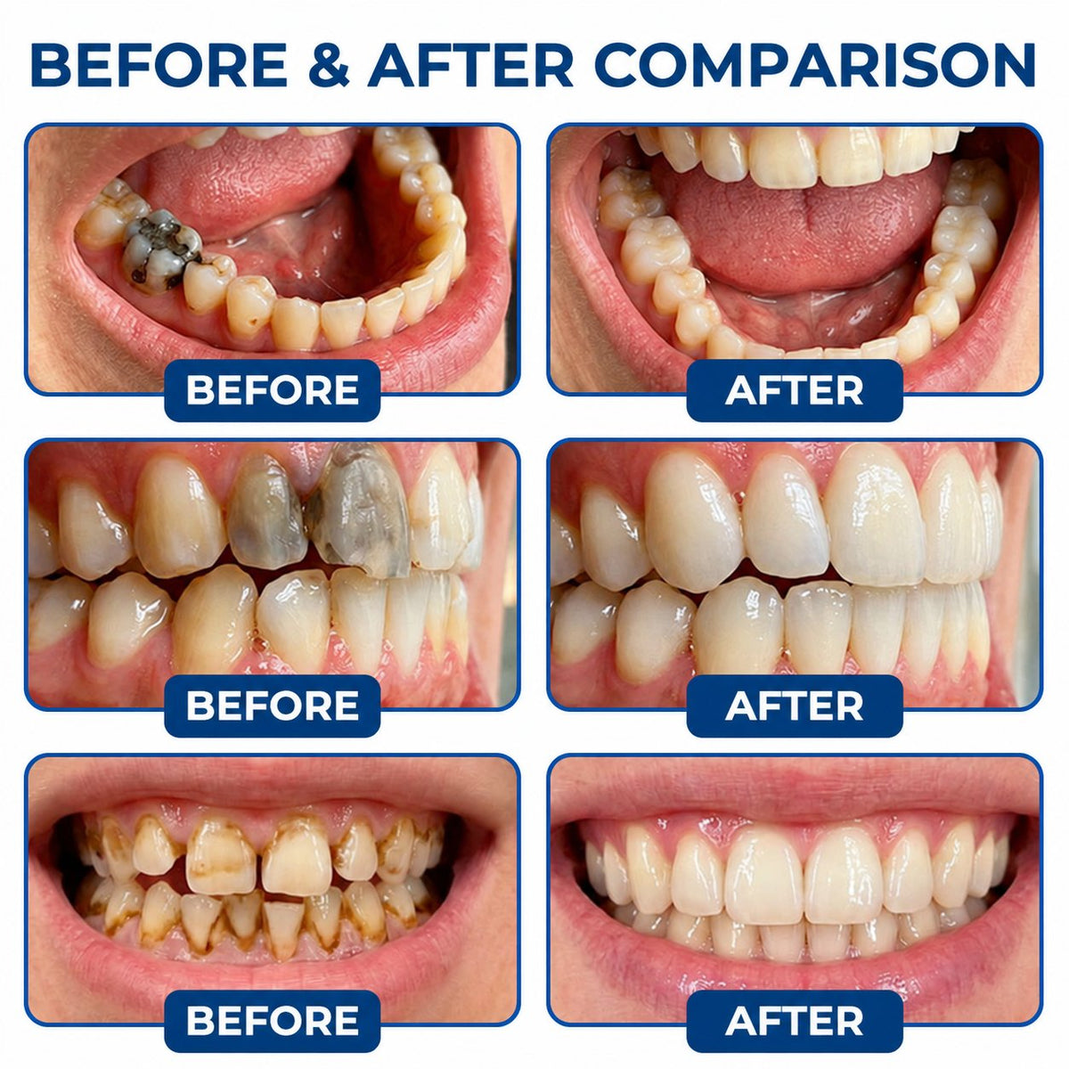🗽🎁Dr.Fachmer® DentRestore Tooth Repair & Filling System