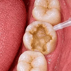 Dr.Fachmer® DentRestore Tooth Repair & Filling System❤️❤️❤️❤️